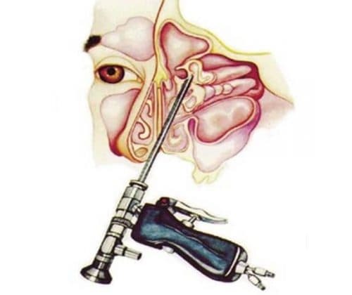 frontal sinus opening using an endoscope