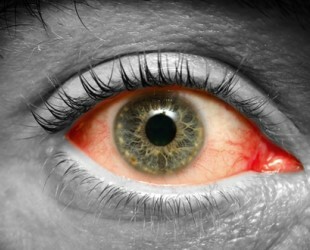 ¿Qué puede significar el enrojecimiento de los ojos?