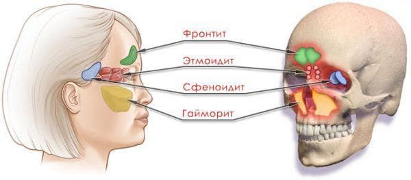 Disease etmoiditis and its symptoms