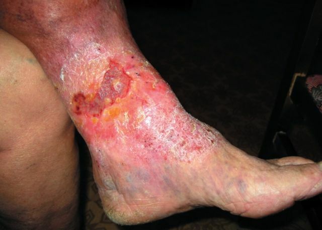 Eczema varicoso nas pernas, como complicação de doenças flebológicas