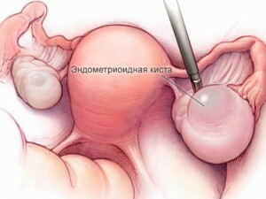 Ovarian cyst: code on microbial 10