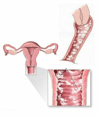 Kako i kako liječiti vulvitis kod žena: masti, lijekovi, čepići