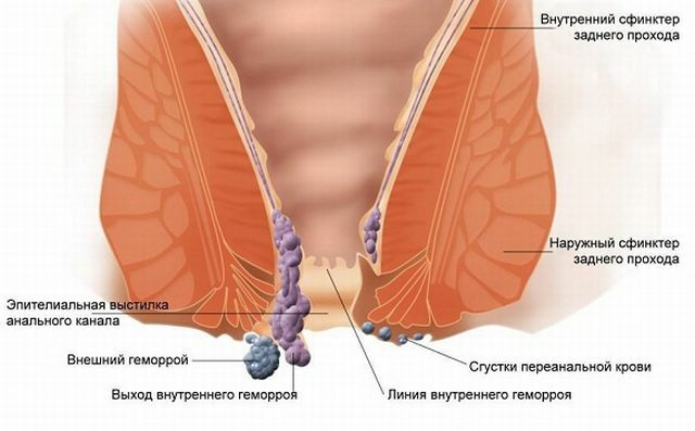 Hemorróidas internas e externas