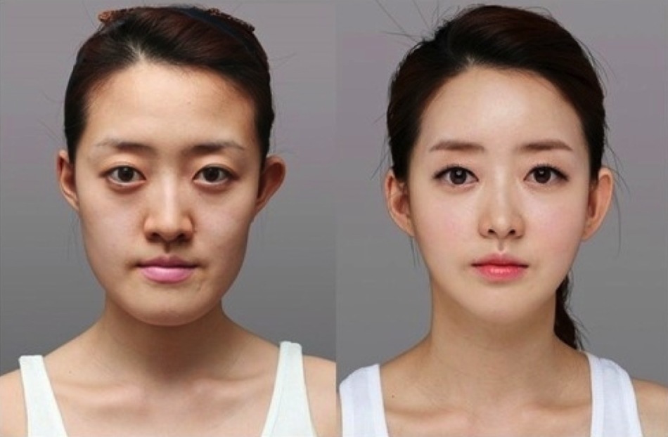 How safe is plastic surgery? What you need to know about plastic surgery?