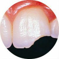 מה לעשות אם פיסה של שן יש פיצול