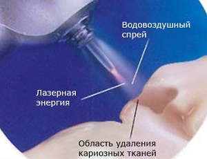 Tratamento de doenças de dentes com laser é moderno e indolor