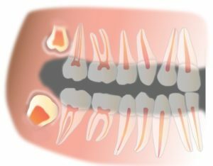 Tirei um dente de sabedoria: quantos curarão a goma?