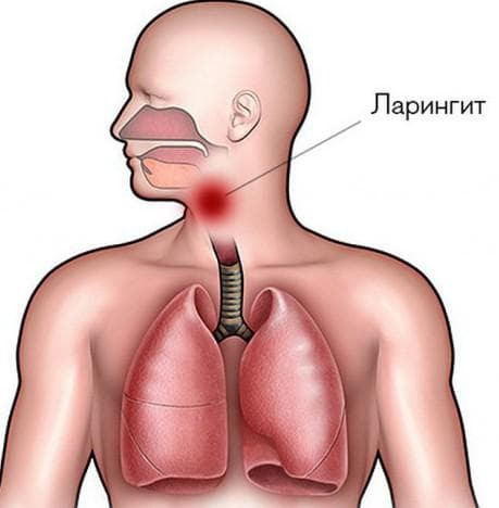 behandeling van laryngitis bij kinderen