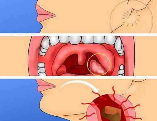 acute bacterial tonsillitis