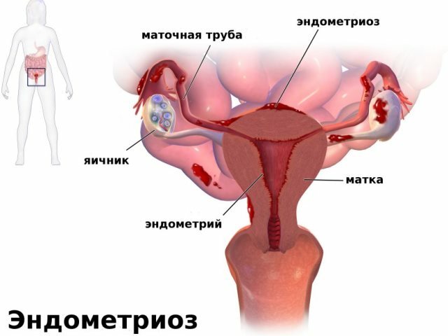 Como a homeopatia funciona com a menstruação