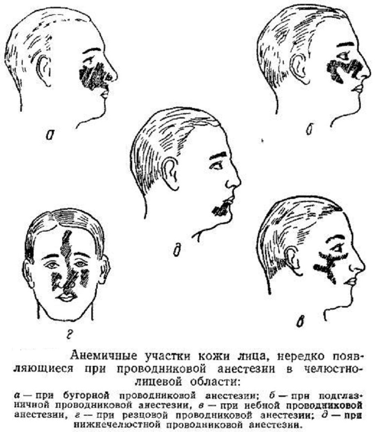 Anestesi tuberial intraoral dan ekstraoral dalam kedokteran gigi