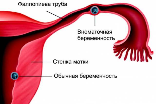 Główne przyczyny prawostronnego bólu podczas menstruacji