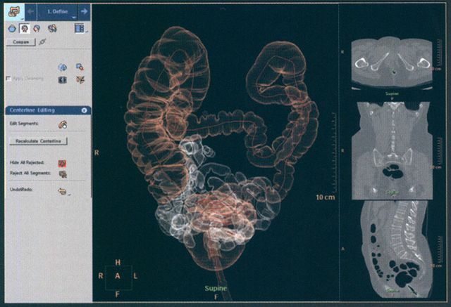 Colonoscopia virtual - um método inovador para o diagnóstico do trato gastrointestinal