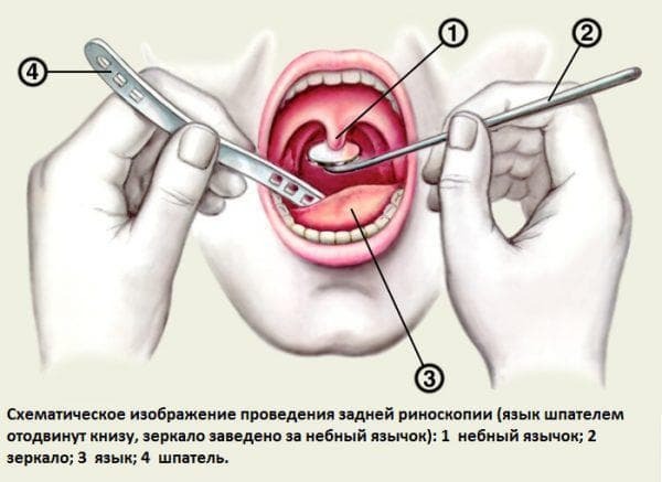 Symptomen van chronische tonsillitis bij volwassenen