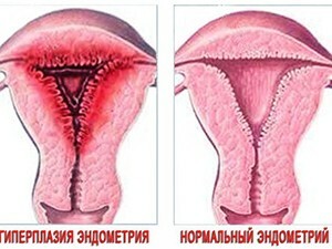 Rozrost endometrium z menopauzą