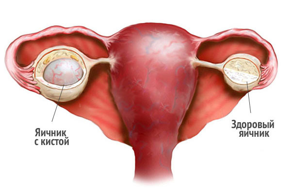 Unexpected situation - the cyst burst during monthly periods: sensations, actions of the girl and doctors 1