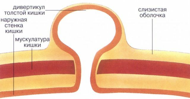 Causas, sintomas e tratamento da diverticulose do cólon