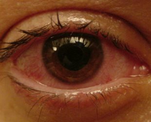 Olhos de uveíte como uma combinação de doenças da coróide