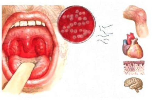 complications from bacterial tonsillitis