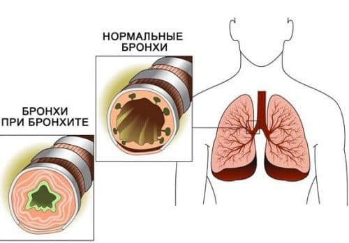 hypertrofische tracheitis