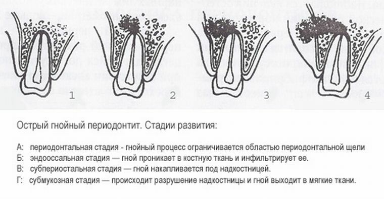 Картинки хронический периодонтит