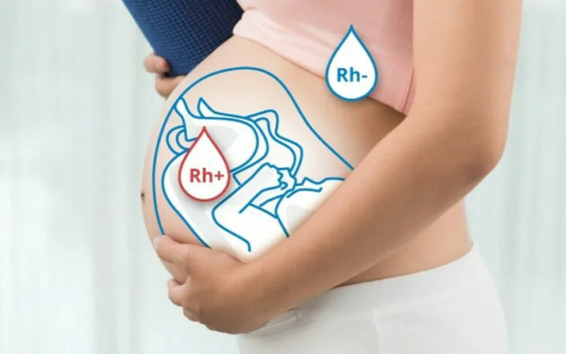 Reesuskonflikti raskauden aikana: mitä se tarkoittaa, oireet, miten välttää