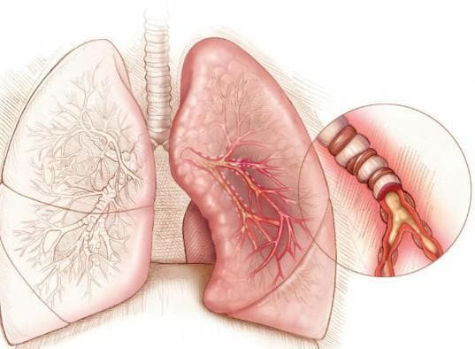 nonotopic asthma