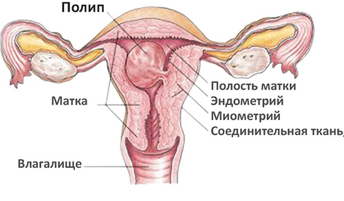 Por que existe um pólipo endometrial