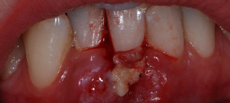 Penyebab, gejala dan pengobatan nekrosis gingiva dan jaringan giginya keras