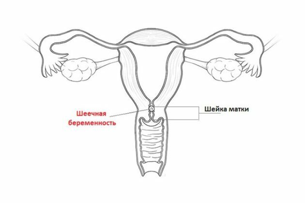 Embarazo cervical: signos, diagnóstico, código ICD-10, tratamiento, revisiones