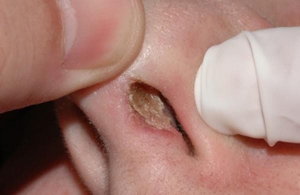 How and what to treat sores in the nose in adults and children