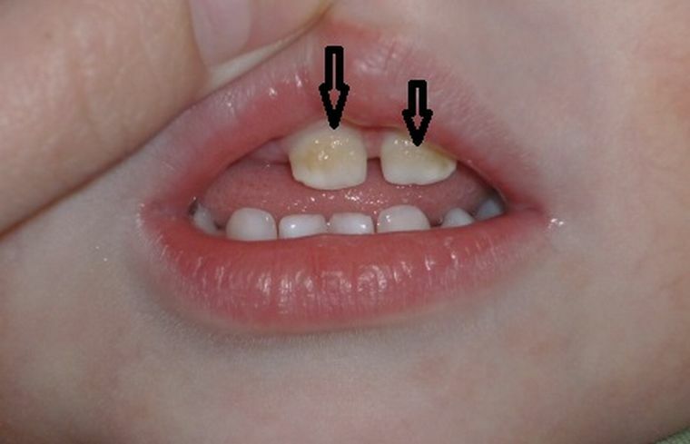 Causes, treatment and prevention of dental caries in children