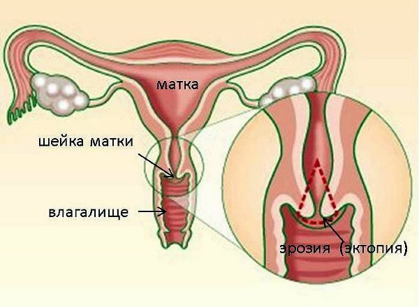 Testes comuns para erosão cervical antes e depois do tratamento