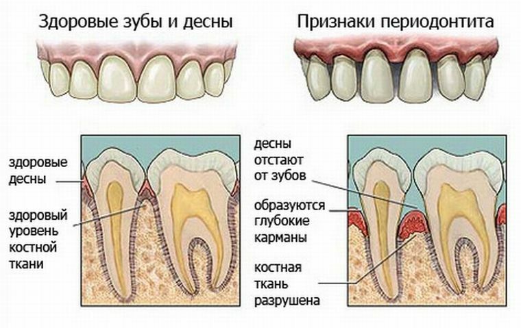 Periodontitis apikal: gejala, klasifikasi, pengobatan