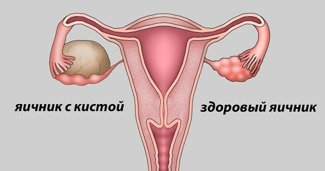 Por que houve inflamação do cisto do ovário e os métodos de tratamento