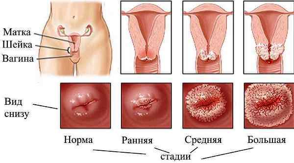 Seberapa efektif dan amannya adalah kauterisasi erosi dengan "Surgitron"