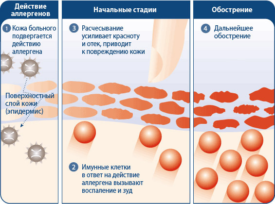 Dermatosis menstruasi atau alergi terhadap menstruasi: penyebab kemunculan dan metode pertarungan