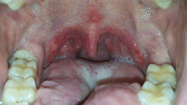 Stomatitis על tonsils: איך לרפא ulcers ולהסיר ציפוי לבן על השקדים?