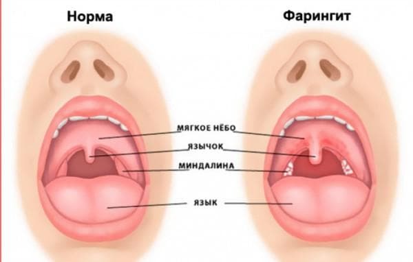 faryngitis en laryngitis