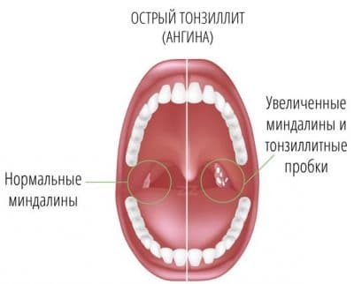 acute tonsillitis