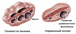 Monthly with polycystosis of the ovaries