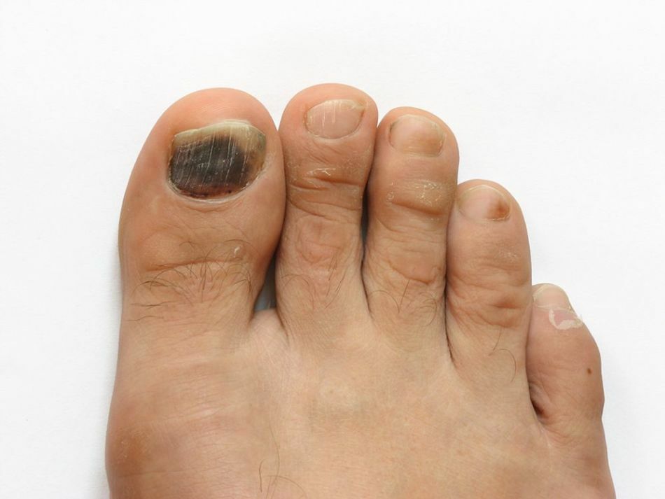 Deformácia nechtov na rukách a nohách: príčiny a liečba. Aká je deformácia nechtu na palci a malíčku nohy a rúk?