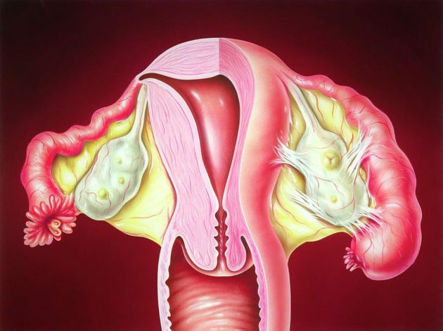 Kako i kako liječiti salpingitis kod žena