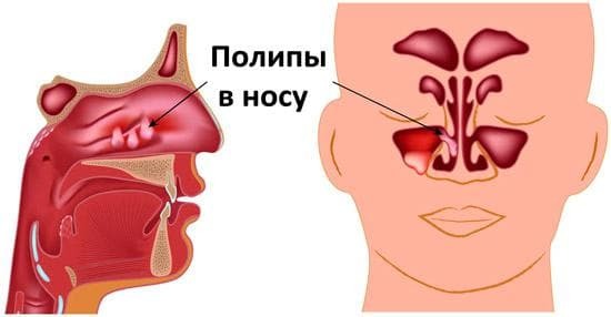 polyps in the nose in a child symptoms