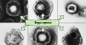 Herpes with monthly