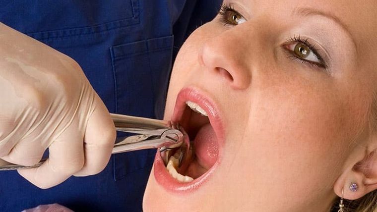 Higiene segura após a extração dentária - quando e como posso limpar os restantes?