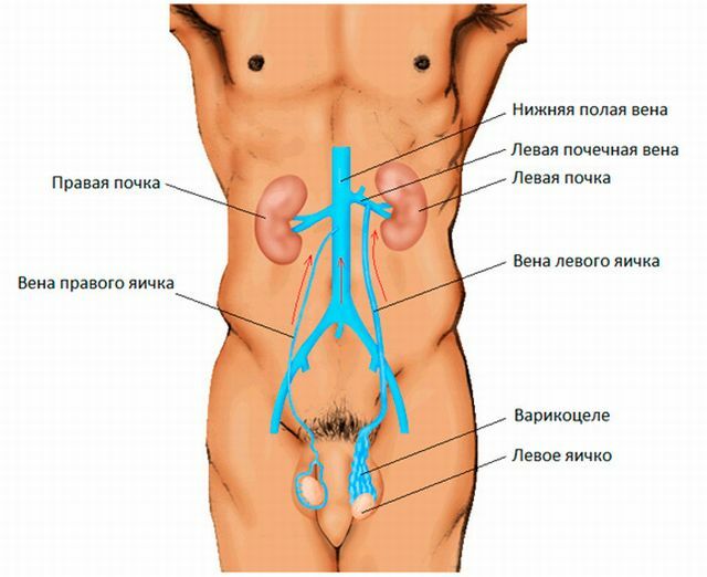 Tratamento de testículos varicóticos sem cirurgia e cirurgia