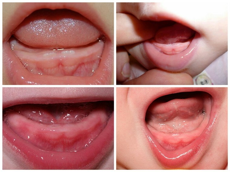 Sintomas e sinais de dentição em crianças