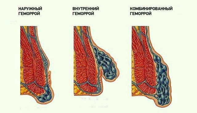 Tipos de hemorróidas