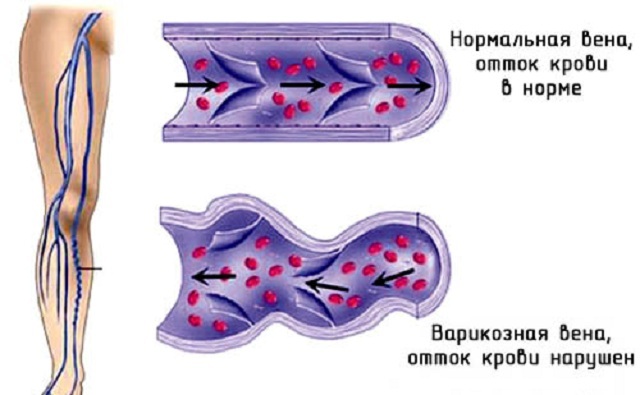 Żylaki